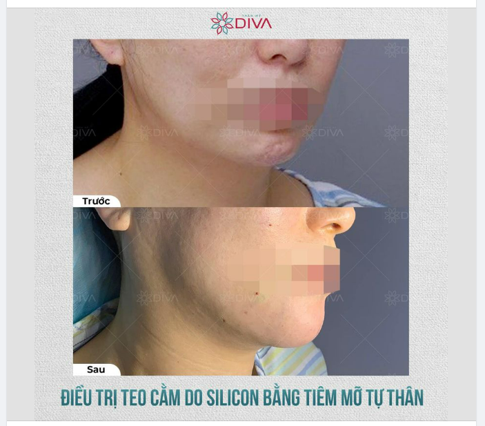 CẢI THIỆN CẰM NHĂN NHEO CO RÚM BẰNG PHƯƠNG PHÁP TIÊM MỠ COLEMAN