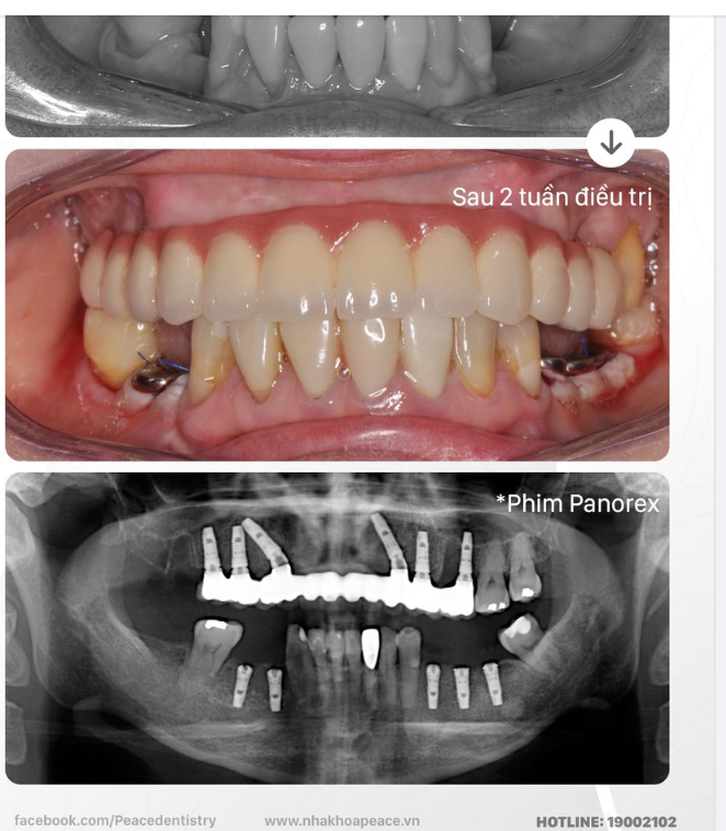 Ca lâm sàng All-on-6 Implant hàm trên thay thế hàm tháo lắp lâu năm và cấy 5 Implant thường quy ở hàm dưới cho khách hàng Việt Kiều.