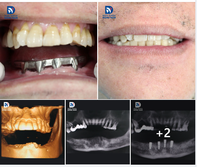 CASE THỰC TẾ 14 - IMPLANT ALL ON 4 HÀM DƯỚI HIỆU QUẢ, TIẾT KIỆM