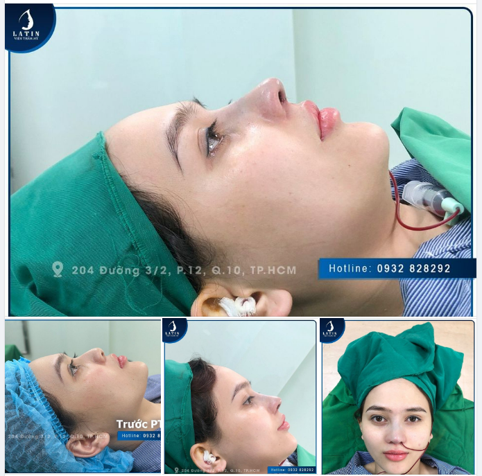 Kết quả nâng mũi cấu trúc lót megaderm