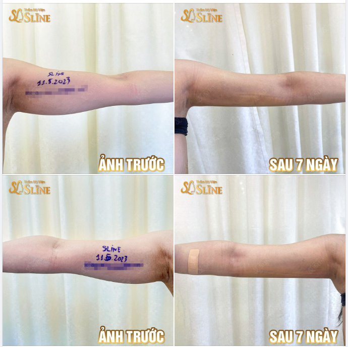HÚT MỠ CÁNH TAY GIẢI QUYẾT NGAY VẤN ĐỀ