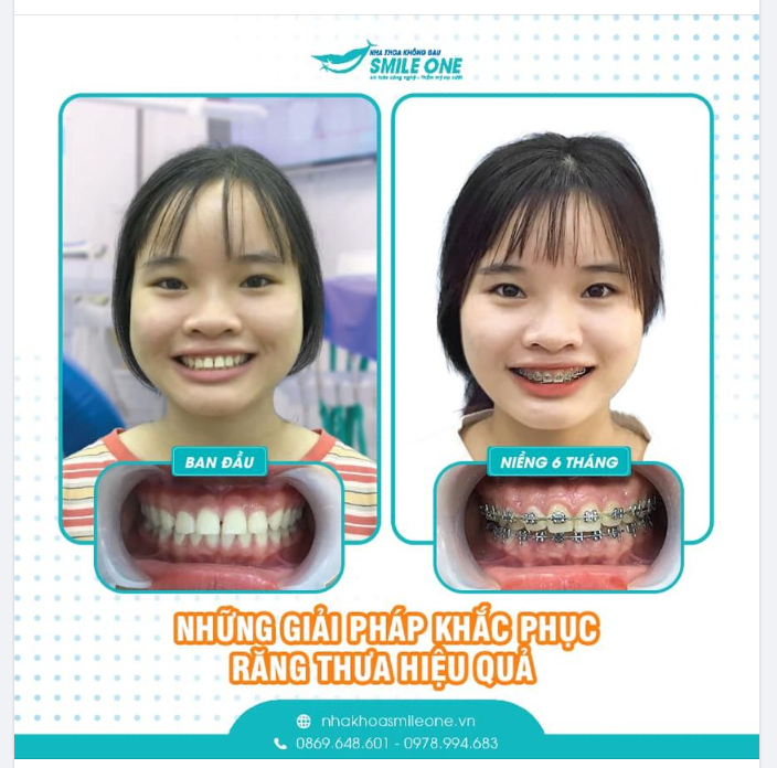 Cái răng, cái tóc là góc con người, vì vậy đừng để hàm răng thưa lấy đi nụ cười xinh xắn và làm bạn kém thẩm mỹ hơn nhé!