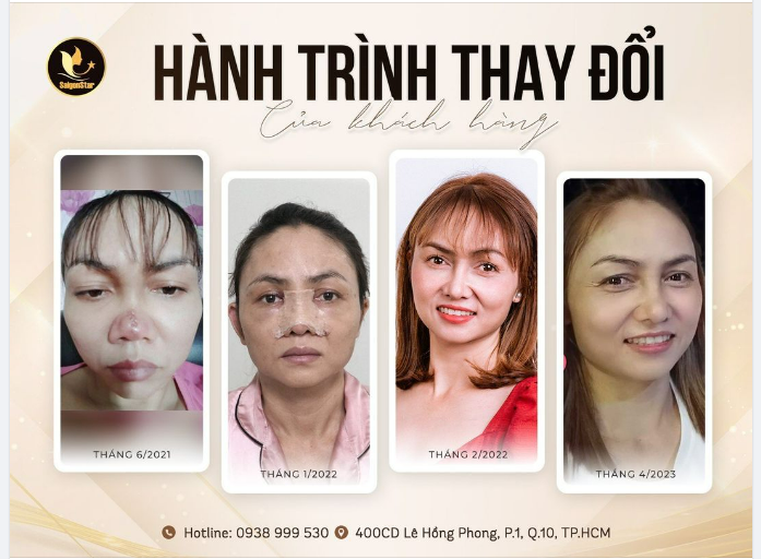 HÀNH TRÌNH THAY ĐỔI CỦA CHỊ LÊ THỊ ĐIỆP SỬA MŨI HỎNG – CHỮA TÂM HỒN MÙA 2