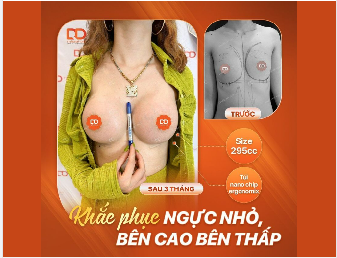KHẮC PHỤC NGỰC TEO LÉP, BÊN CAO BÊN THẤP