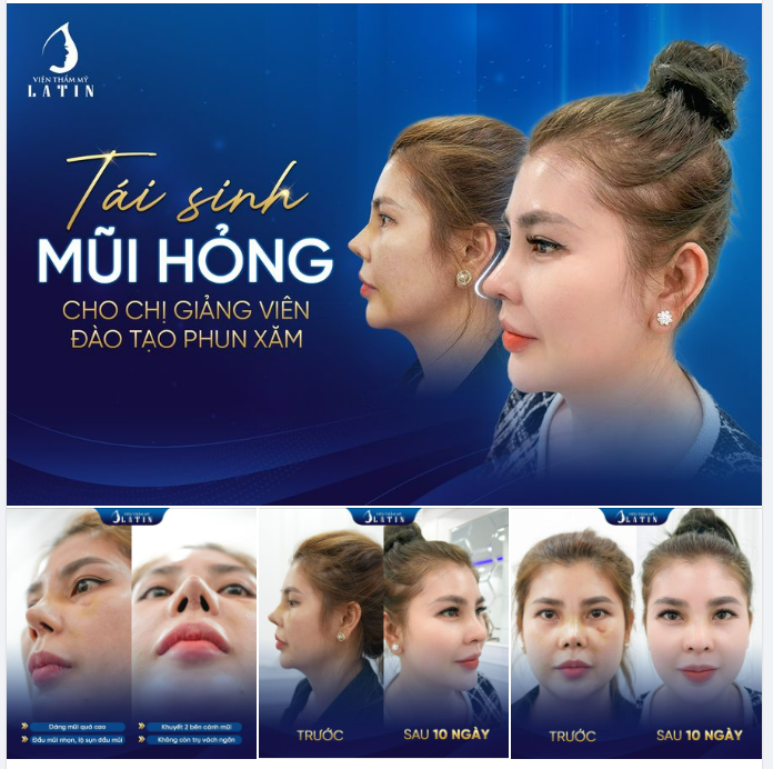 Cùng theo dõi hành trình sửa mũi đầy gian nan của chị khách hàng đã từng nâng mũi 4 lần ở nơi khác nhưng KHÔNG THÀNH CÔNG