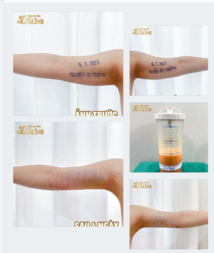 HÚT MỠ CÁNH TAY GIẢI QUYẾT NGAY VẤN ĐỀ