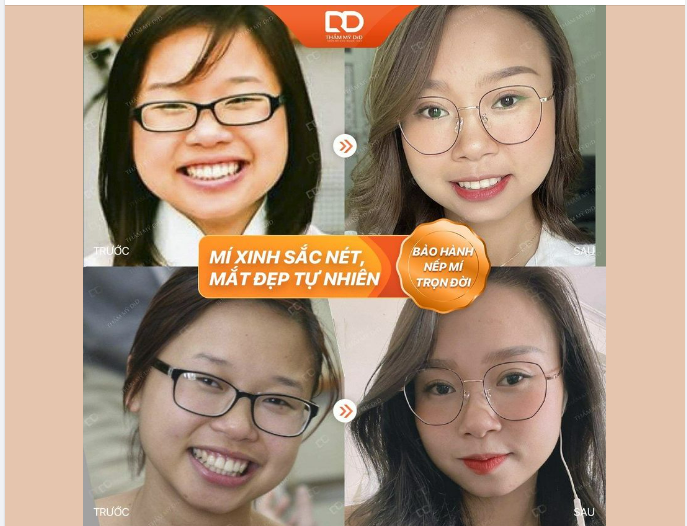 TẠM BIỆT MÍ NHỎ U BUỒN NHẬN NGAY MÍ XINH SẮC NÉT.