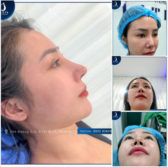 Chiếc mũi nâng hỏng thay đổi như thế nào sau 7 ngày sửa mũi tại Latin