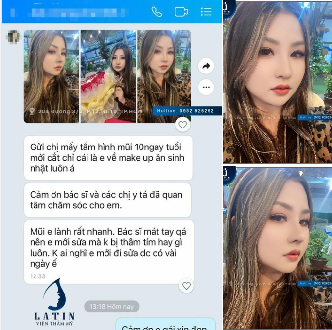 Một chiếc Feedback xịn xò của khách hàng sau khi Nâng Mũi 10 ngày tại Latin