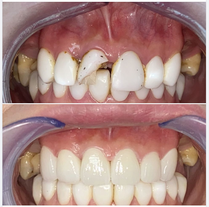 Một trường hợp làm lại 6 răng sứ từ nơi điều trị khác của bác sĩ Thủy, chi nhánh 292 Huỳnh Văn Bánh, Phú Nhuận!