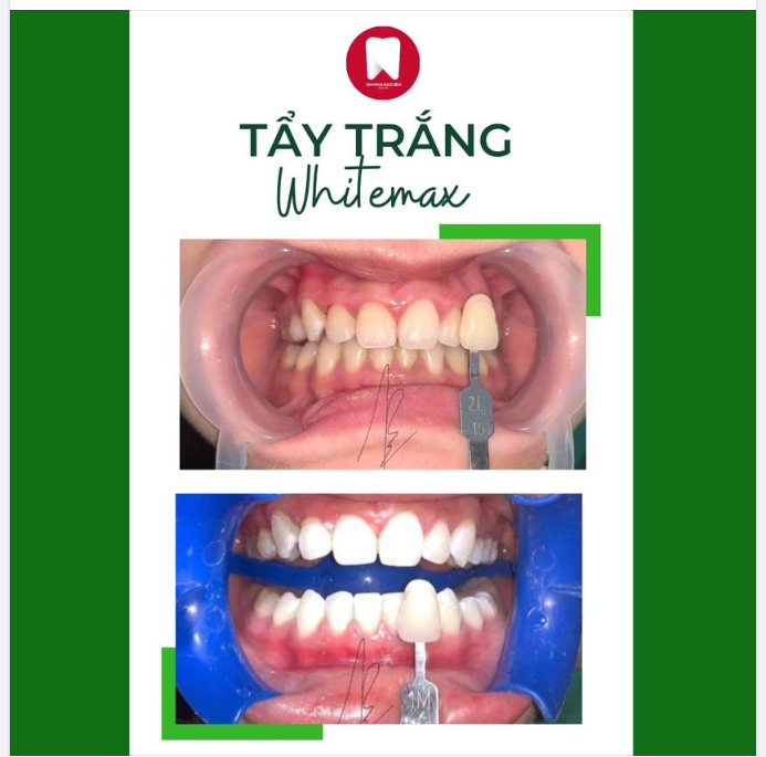 TẨY TRẮNG RĂNG CÓ Ê BUỐT KHÔNG?