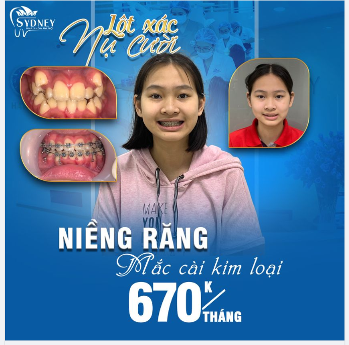 Niềng răng khấp khểnh có khó không?