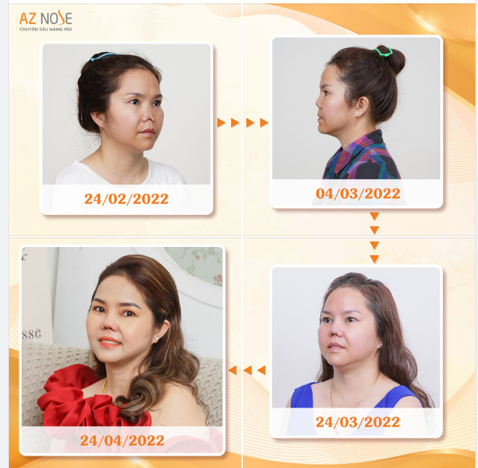 “Chỉ mong mũi tôi bình thường như bao người khác là tôi mãn nguyện lắm rồi”