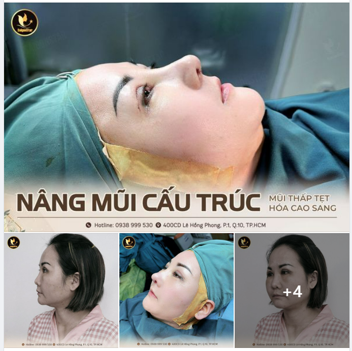 NÂNG MŨI CẤU TRÚC MŨI THẤP TẸT HÓA CAO SANG