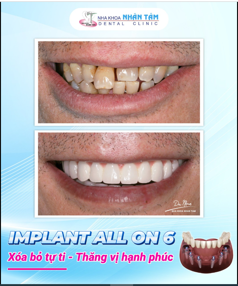 Tái tạo răng mới - xóa bỏ tự ti với phương pháp Implant All On 6
