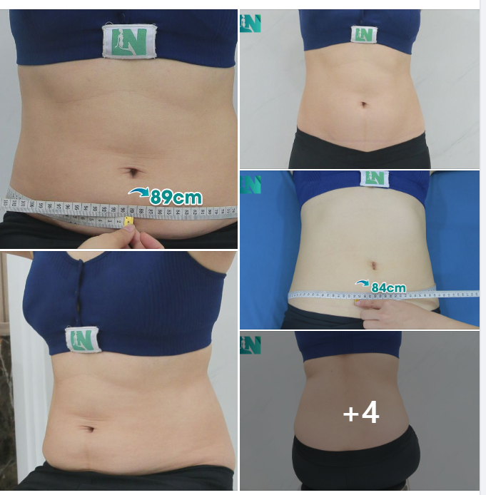  HÚT MỠ TẠO DÁNG THẨM MỸ  LẤY LẠI DÁNG VÓC SAU SINH CHO CHỊ KH (8X) LỰA CHỌN LÀM ĐẸP 