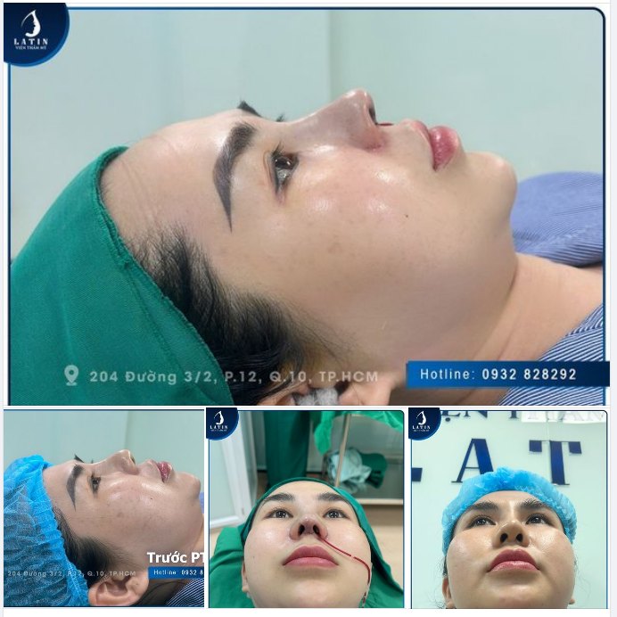 MŨI CẤU TRÚC SỬA LẠI SÓNG SURGIFORM