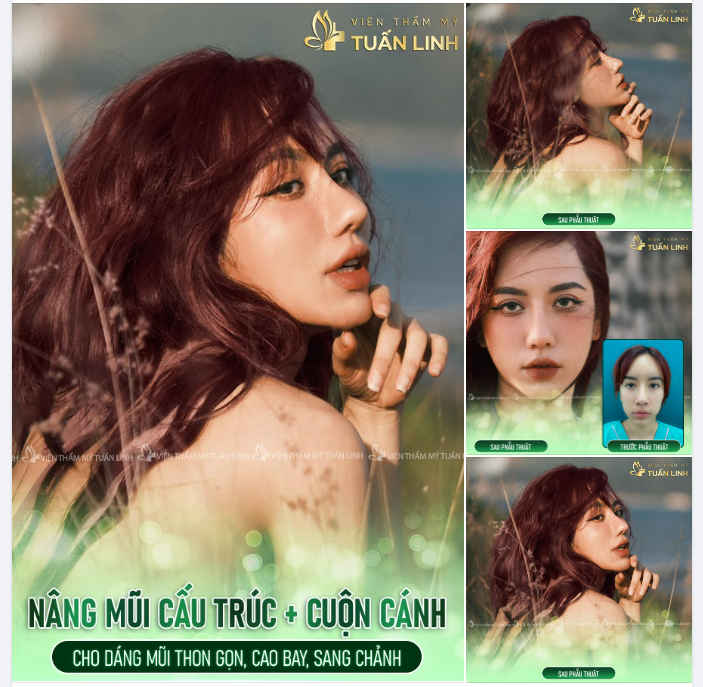 Chiếc nhan sắc xinh đẹp sau nâng mũi này đã xứng đáng cho bạn đặt lịch làm đẹp tại Tuấn Linh ngay hôm nay chưa ạ???