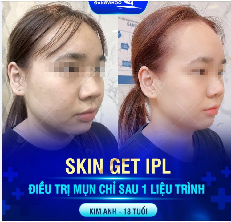 Sau khi điều trị mụn tại Bệnh viện Thẩm mỹ Gangwhoo, Bé Kim Anh đã lột xác với diện mạo hoàn toàn mới chỉ sau 1 liệu trình cùng công nghệ Skin Get IPL: