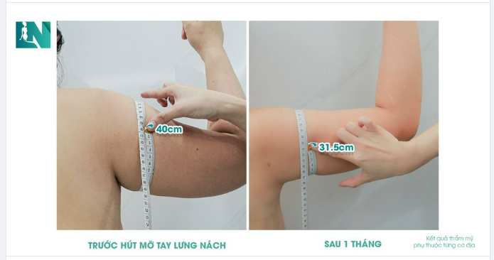 GIẢM 8,5CM MỠ VÙNG CÁNH TAY SAU 45 PHÚT – BÍ QUYẾT BẮP TAY THON!