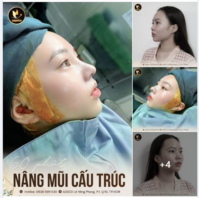 60 PHÚT NÂNG MŨI CẤU TRÚC XINH, SANG VÀ KHÍ CHẤT