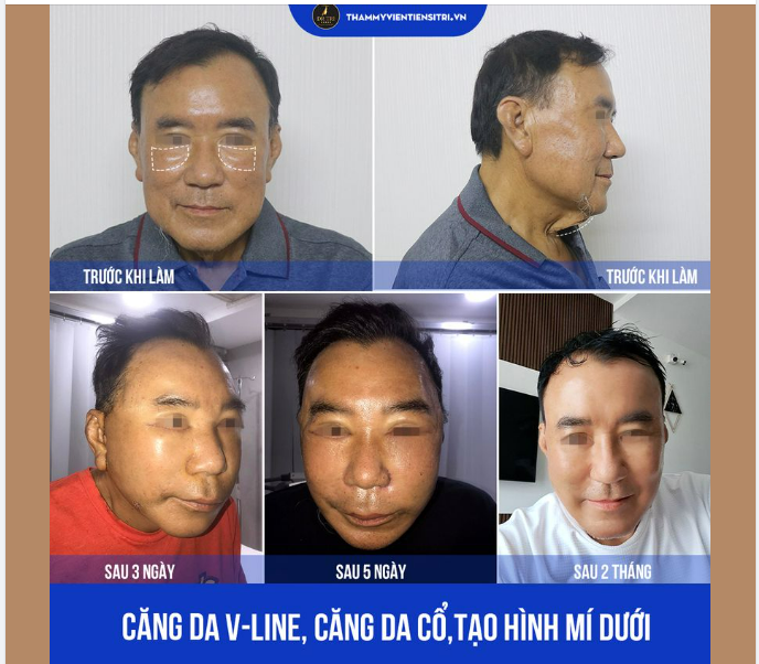 HÀNH TRÌNH 2 THÁNG CĂNG DA VLINE ĐỂ TRẺ HÓA
