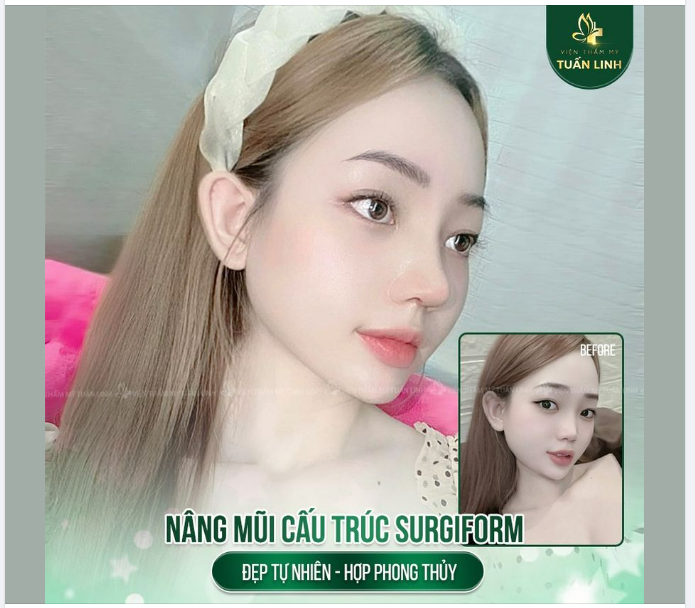 Một chiếc mũi đẹp tự nhiên nhưng cũng không kém phần sắc nét giúp gương mặt của bạn khách hàng xinh đẹp hơn, có điểm nhấn và nổi bật hơn rất nhiều.