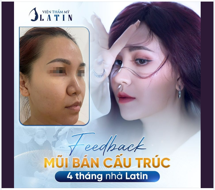 MŨI BÁN CẤU TRÚC LÊN DÁNG CHUẨN FORM SIÊU NÉT