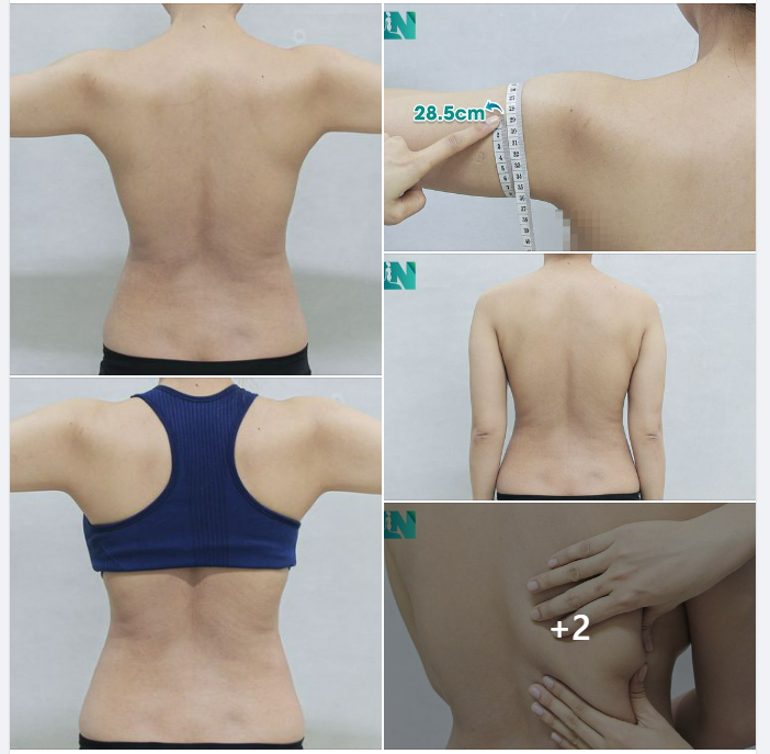 HÚT MỠ TẠO DÁNG THẨM MỸ VÙNG LƯNG, CÁNH TAY, NÁCH CHO CHỊ KH 9X – HIỆN THỰC GIẤC MƠ THON GỌN: LƯNG NUỘT – EO THON. TRỰC TIẾP 15H00 HÔM NAY.
