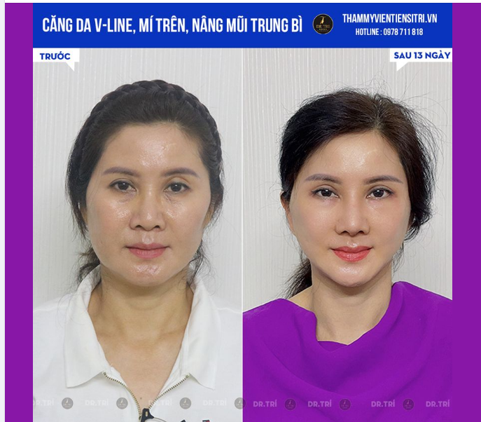 VỪA TRẺ HÓA VỪA CÂN CHỈNH GƯƠNG MẶT