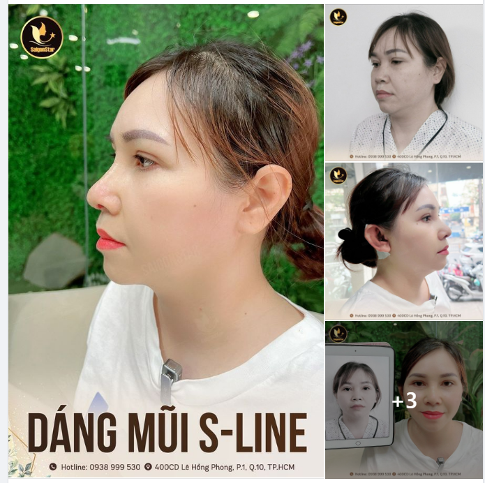 DÁNG MŨI S-LINE TẠO BỞI DR. HOẠT