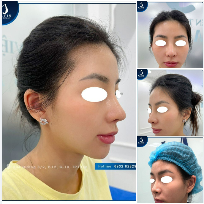 Mũi đã nâng ở nơi khách không thành công, sửa lại có đẹp không