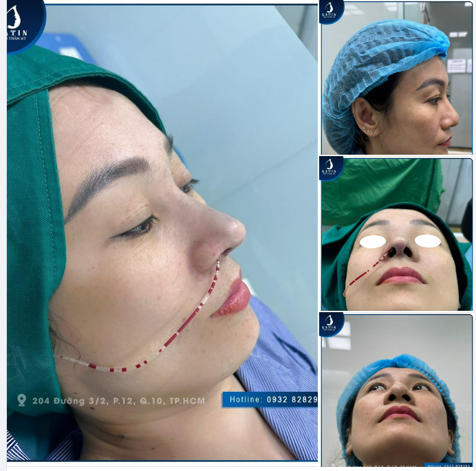 Khắc phục tình trạng mũi bao xơ, sửa hỏng cho khách hàng đã từng nâng mũi ở nơi khác không thành công