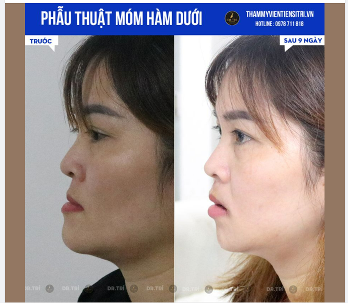SAU 9 NGÀY CHỈNH HÀM MÓM CÓ GÌ KHÁC BIỆT?