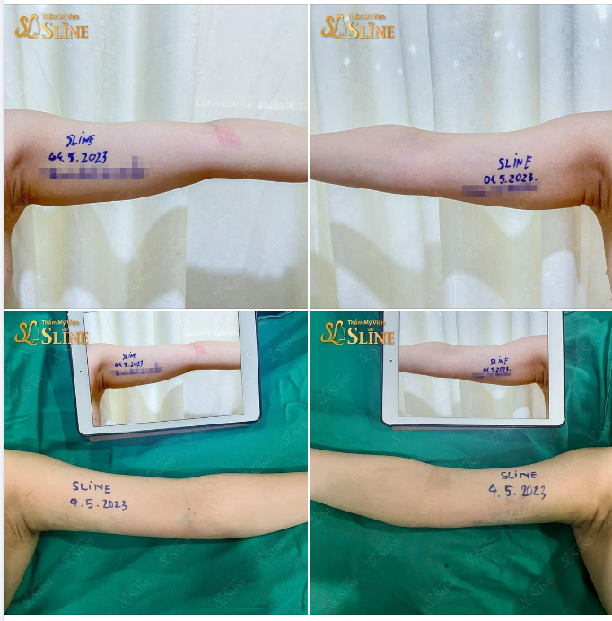 CÁNH TAY CUỒN CUỘN CHẲNG PHẢI TỰ TI