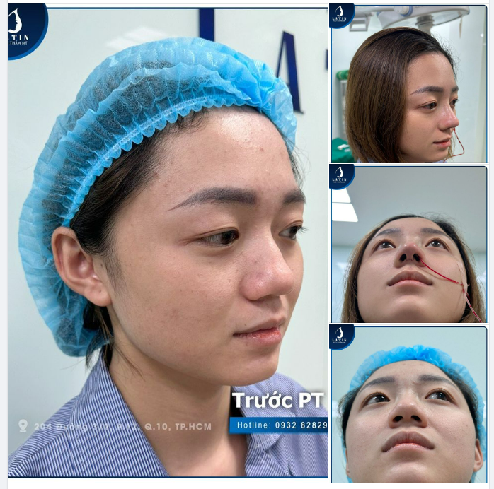 KHẮC PHỤC TÌNH TRẠNG MŨI GỒ, NỀN MŨI TO BÈ CHO BẠN KHÁCH HÀNG TRẺ TUỔI