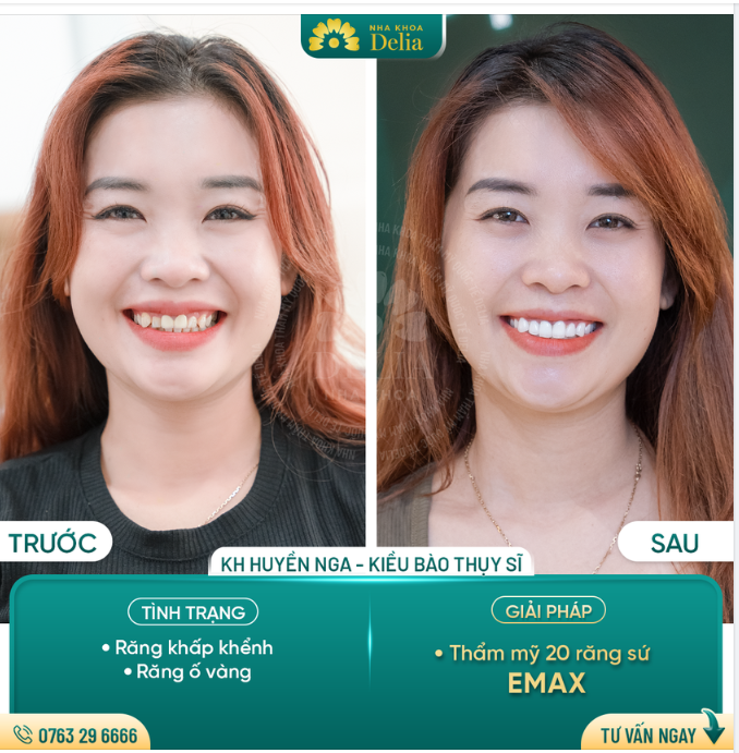 Kiều bào Thụy Sĩ về Việt Nam để khắc phục răng KHẤP KHỂNH, Ố VÀNG