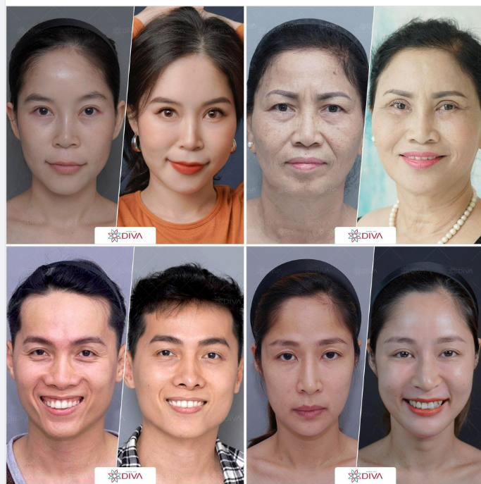 TIÊM MỠ MẶT – TRẺ HÓA GƯƠNG MẶT HỐC HÁC, THIẾU SỨC SỐNG