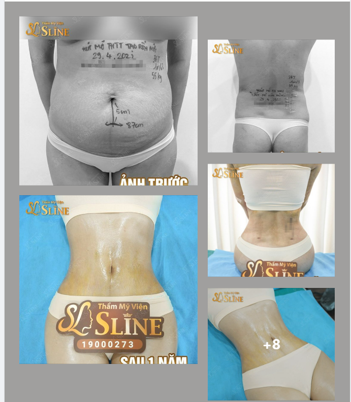 FEEDBACK : HÚT MỠ SIẾT EO 360° - SAU 1 NĂM