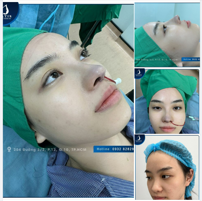 Hoàn thành ca nâng mũi cho em gái thích dáng cao nét nhưng vẫn tự nhiên và hợp mặt