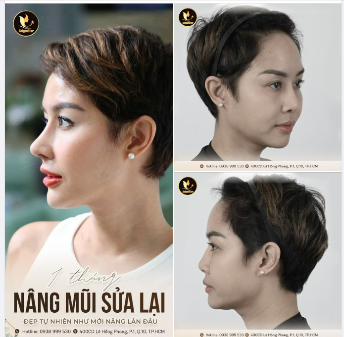 1 THÁNG NÂNG MŨI SỬA LẠI ĐẸP TỰ NHIÊN NHƯ LẦN ĐẦU