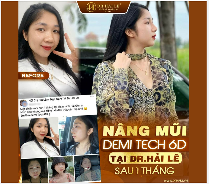 Nâng mũi Demi Tech 6D tại Dr.Hải Lê- Sài Gòn sau 1 tháng