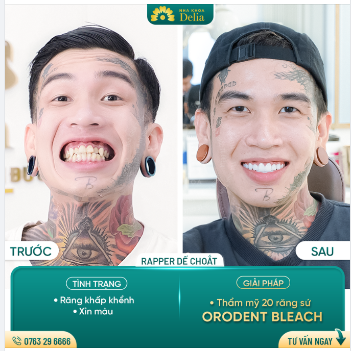 Bọc răng sứ xử lý hoàn toàn: Răng khấp khểnh, hình thể không đều, xỉn màu cho Rapper Dế Choắt