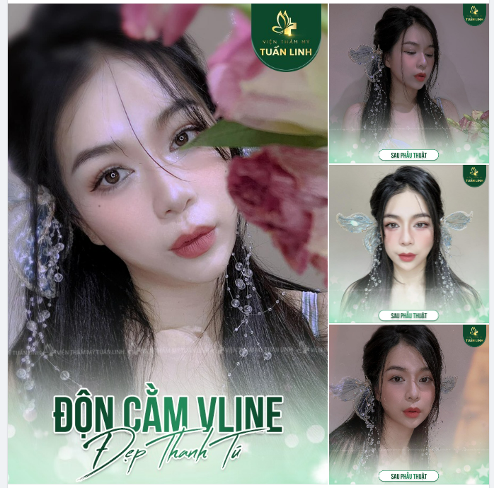 Độn cằm Vline - Cho dáng cằm đẹp tự nhiên, thon gọn thanh tú, hợp phong thủy.