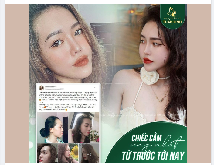 Feedback khách hàng Độn Cằm Vline tại Tuấn Linh - Lời quảng cáo ít tốn giấy mực!! Chị em chấm cho bác sĩ Tuấn Linh bao nhiêu điểm ạ???