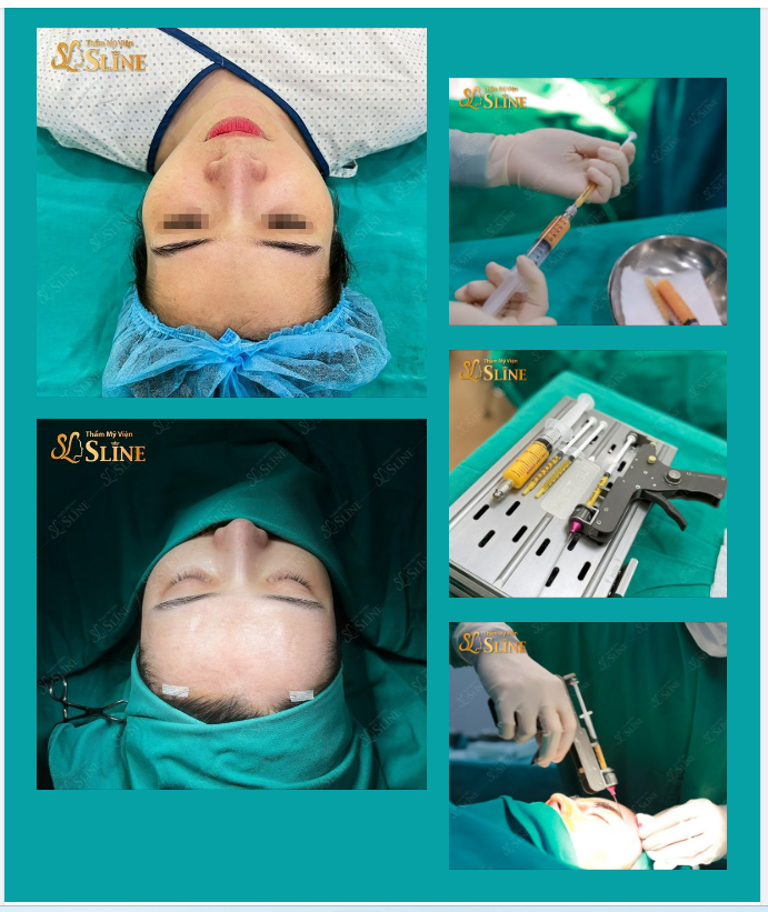 CẤY MỠ THÁI DƯƠNG - TRẺ HÓA GƯƠNG MẶT