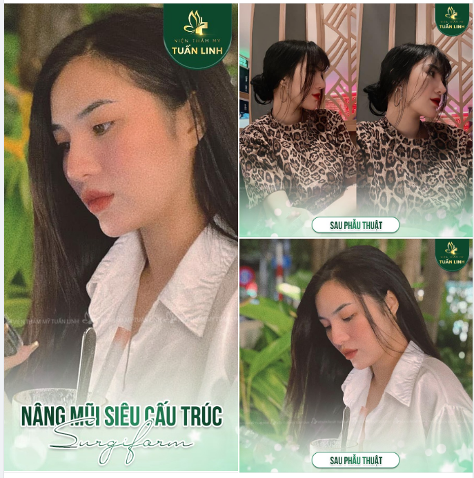 Nâng mũi siêu cấu trúc kết hợp sụn Surgiform Cho dáng mũi bền đẹp mãi về sau.