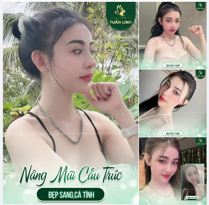 NÂNG MŨI CẤU TRÚC - ĐẸP SANG CÁ TÍNH - CHUẨN HOTGIRL