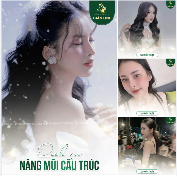 NÂNG MŨI CẤU TRÚC - ĐẸP HOÀN MỸ ĐẾN TỪNG CHI TIẾT!