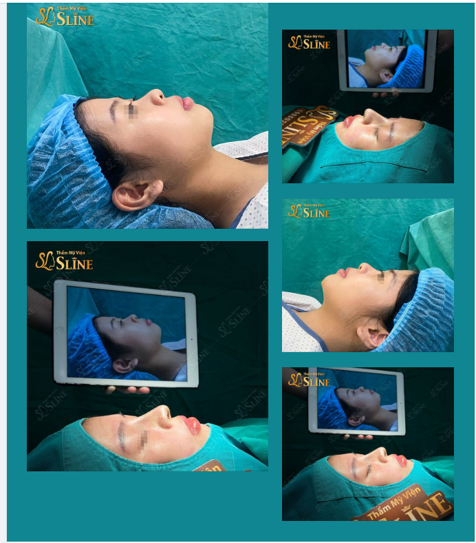 “Nâng mũi Sline, đẹp ngay tức khắc”